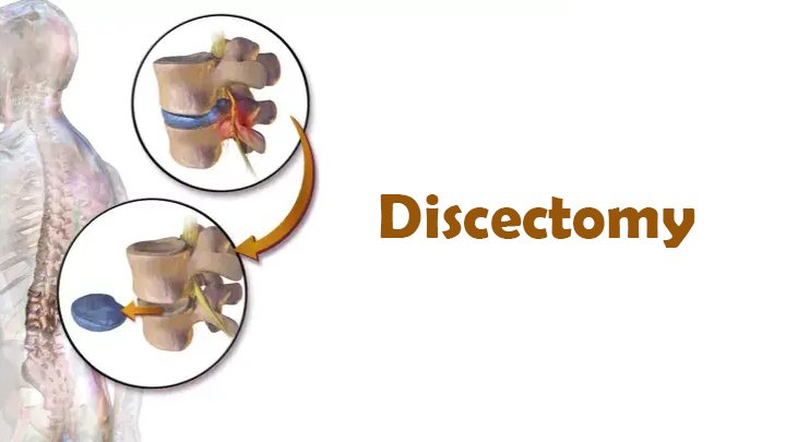 ডিস্ক কেটে ফেলা (Discectomy): অপারেশনের পর স্বাভাবিক চলাফেরা ও করণীয়
