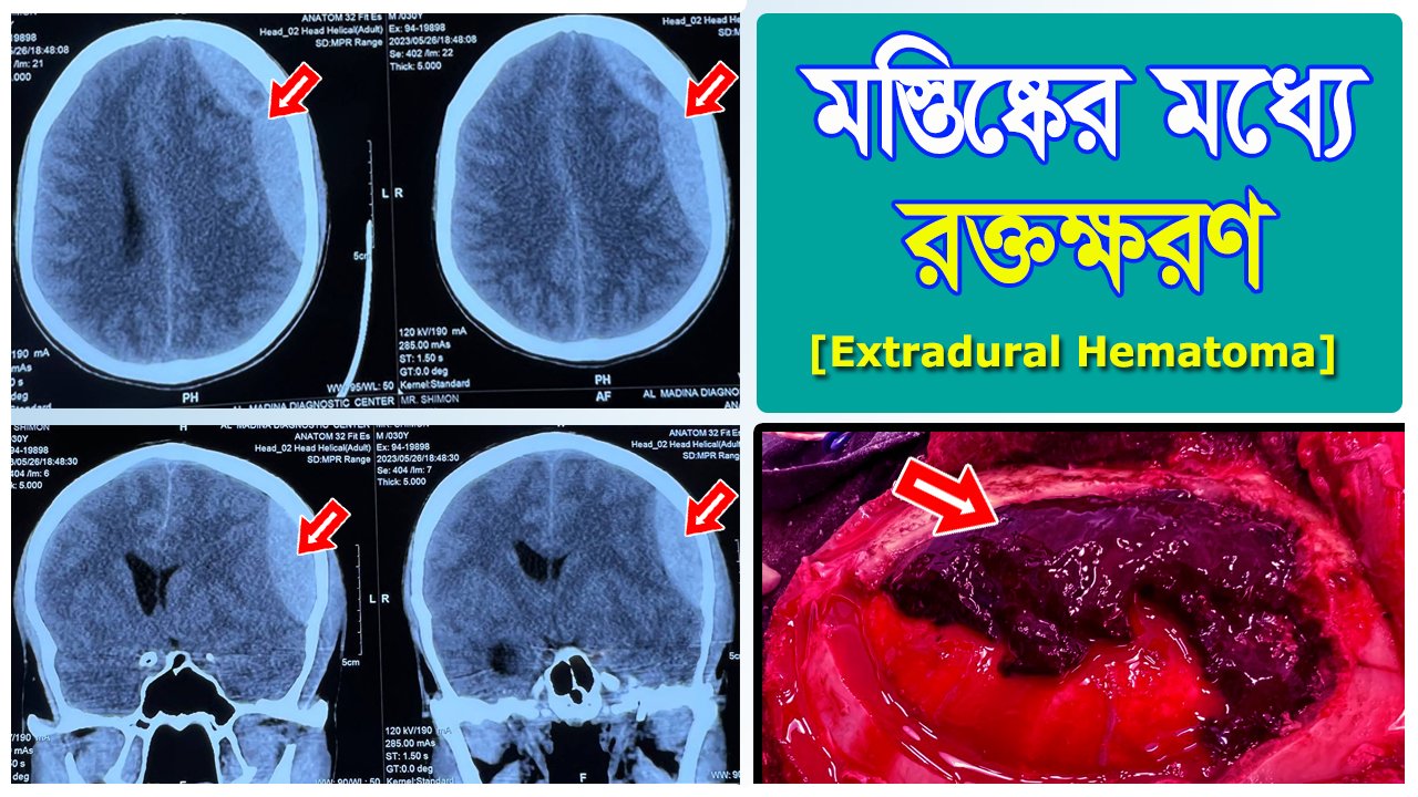মাথার খুলির ভিতরে রক্তক্ষরণ (EDH): কারণ, লক্ষণ ও চিকিৎসা