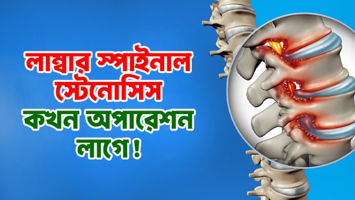 লাম্বার স্পাইনাল ক্যানাল স্টেনোসিস: অপারেশন প্রয়োজন কবে?
