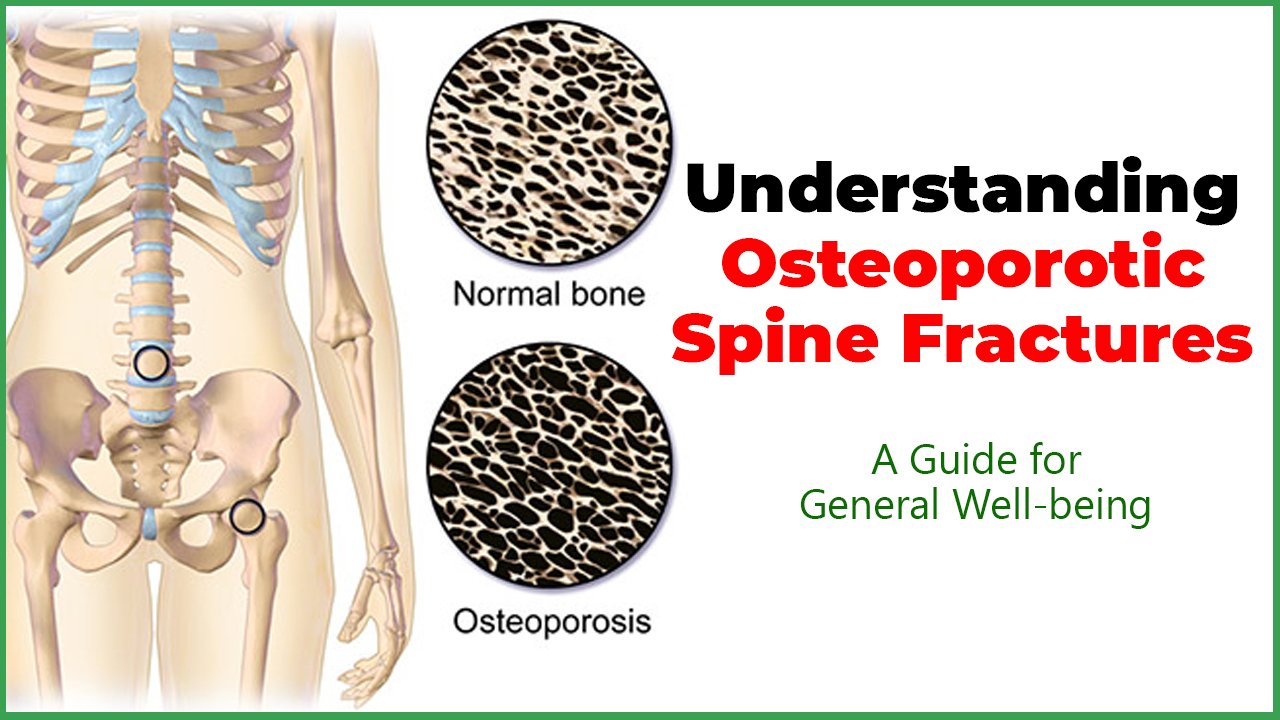 Understanding Osteoporotic Spine Fractures: A Guide for General Well-being