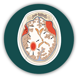 Trauma Neurosurgery